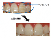 ホワイトニング